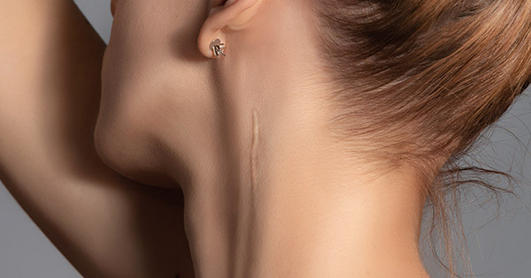 Hypertrophic & Keloid Scars