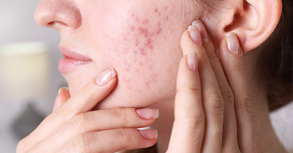 Red Acne Scars