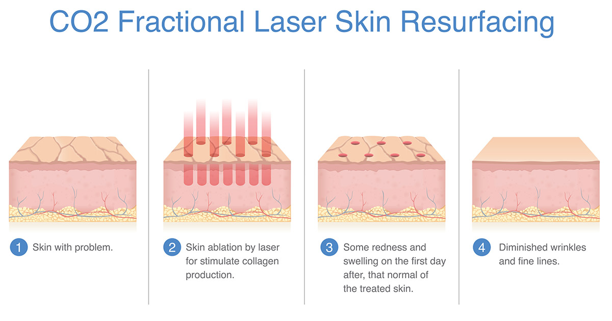 What Affects The Cost Of CO2 Laser Resurfacing