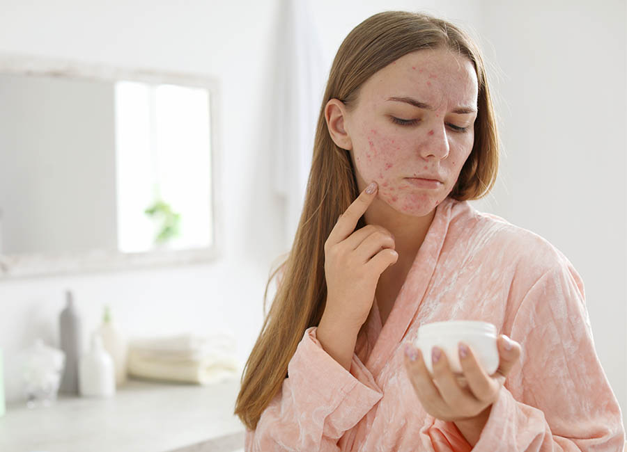 How to Prepare for Acne Scar Treatment